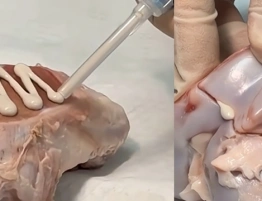 Klej do kości - czy to rewolucja w leczeniu złamań? [Wideo]