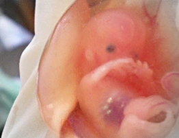 Nowa Zelandia: Dzieci, które przeżyły aborcję, są zostawiane, by umarły