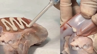 Klej do kości - czy to rewolucja w leczeniu złamań? [Wideo]