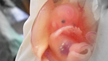 Nowa Zelandia: Dzieci, które przeżyły aborcję, są zostawiane, by umarły