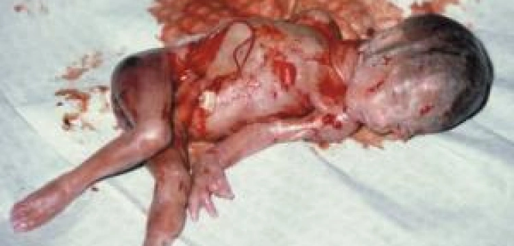 Parlament zalegalizował aborcję do 12 tygodnia ciąży