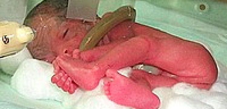 Wcześniaki z coraz większymi szansami na przeżycie