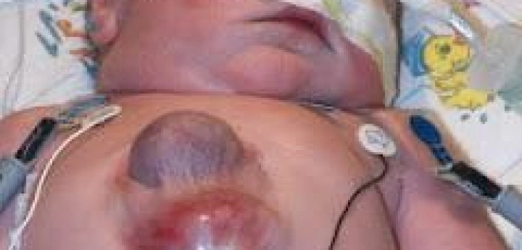 Niesamowita historia dziecka z sercem na wierzchu