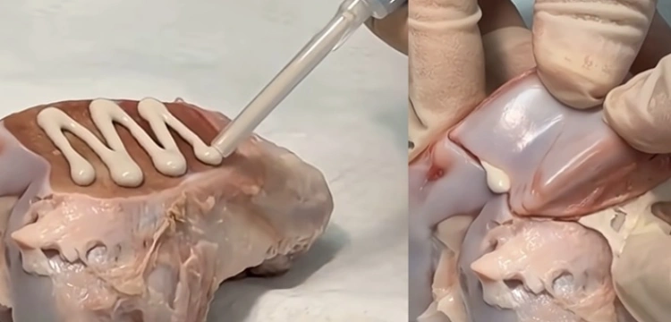 Klej do kości - czy to rewolucja w leczeniu złamań? [Wideo]