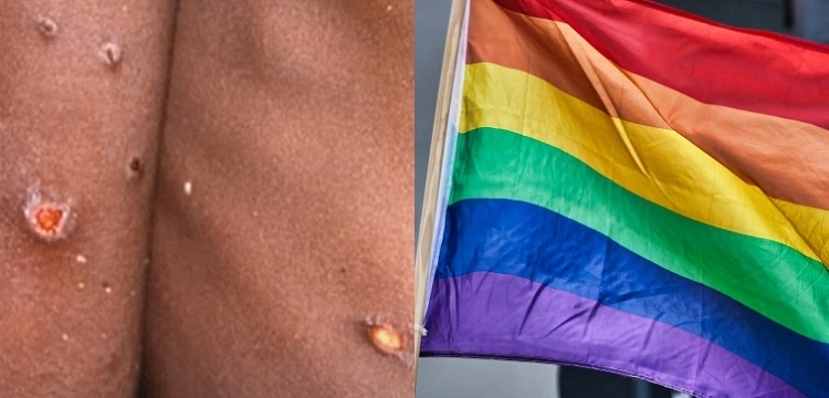 Małpia ospa - "wszystkie przypadki dotyczą mężczyzn". Czy to choroba homoseksualistów?