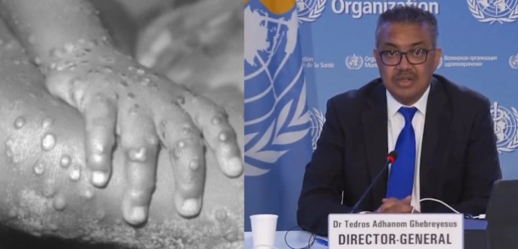 16 tys. przypadków małpiej ospy na całym świecie. Prezes WHO: to globalne zagrożenie!