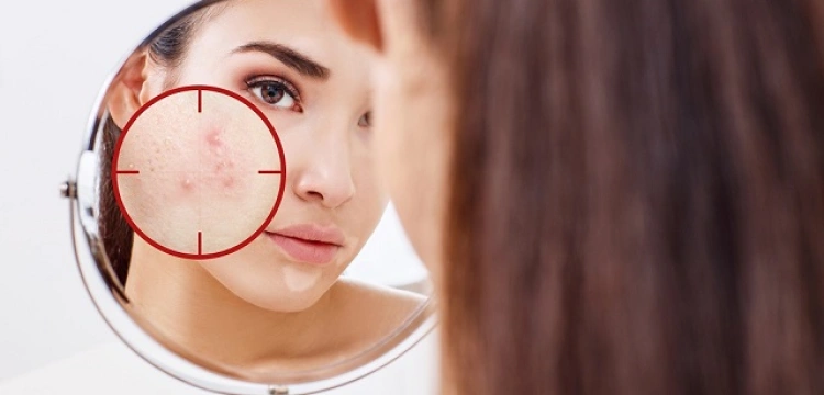 Trądzik różowaty. Co to jest i jak sobie z tym radzić?